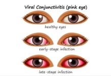 आंखों में देखने से नहीं, छूने से फैल रहा आई फ्लू का संक्रमण, कैसे करें बचाव ?